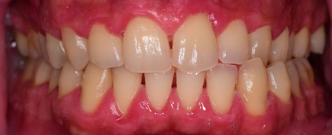  Gum Disease Clean After