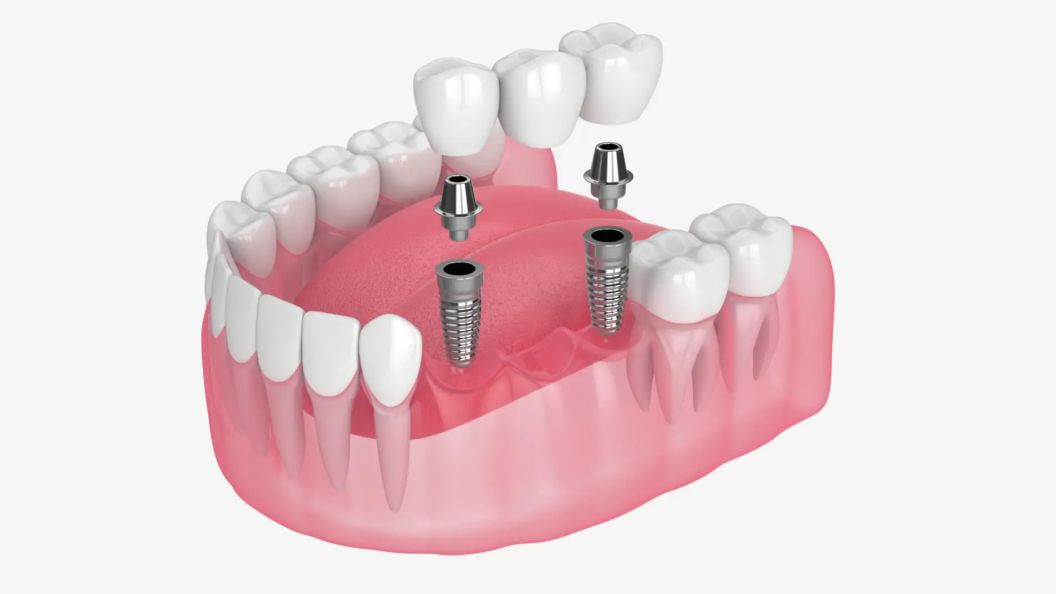 Multiple Implant Video