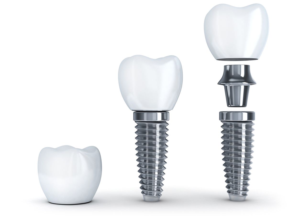 Dental Implants Components