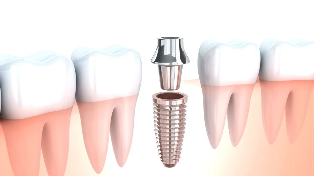 Single Implant Video